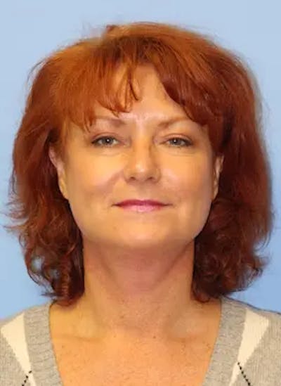 Facelift Before & After Gallery - Patient 302875 - Image 2