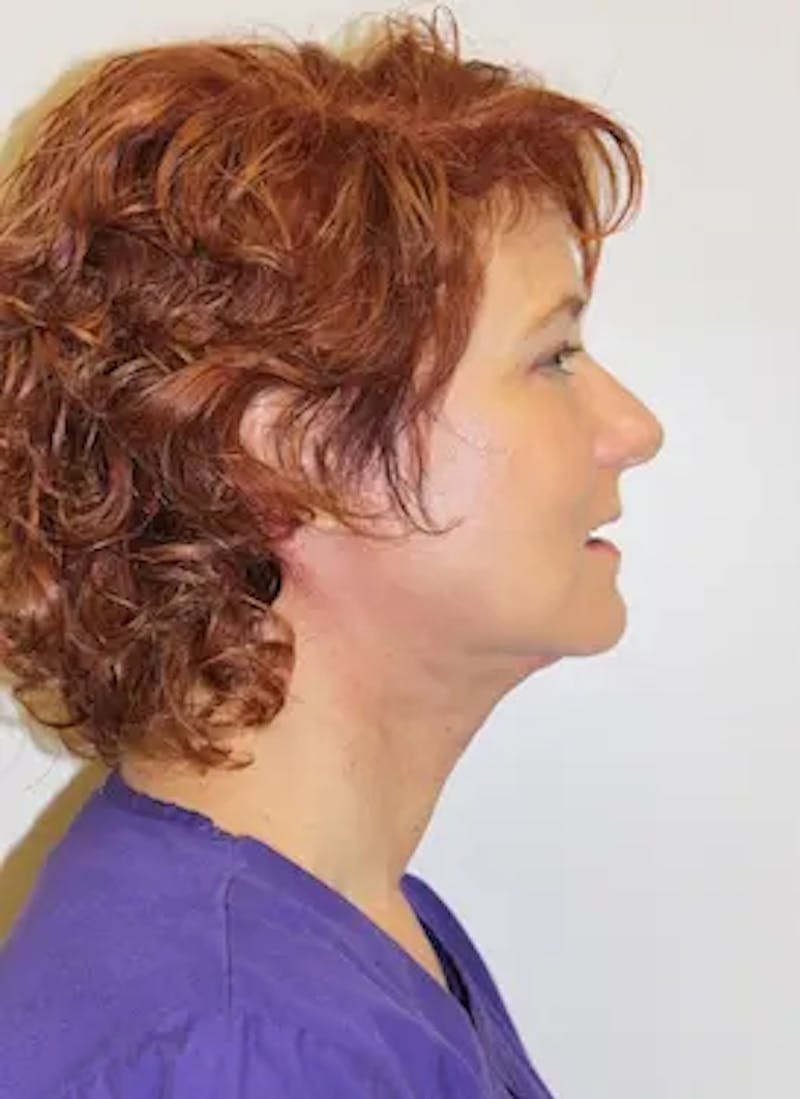 Facelift Before & After Gallery - Patient 302875 - Image 5