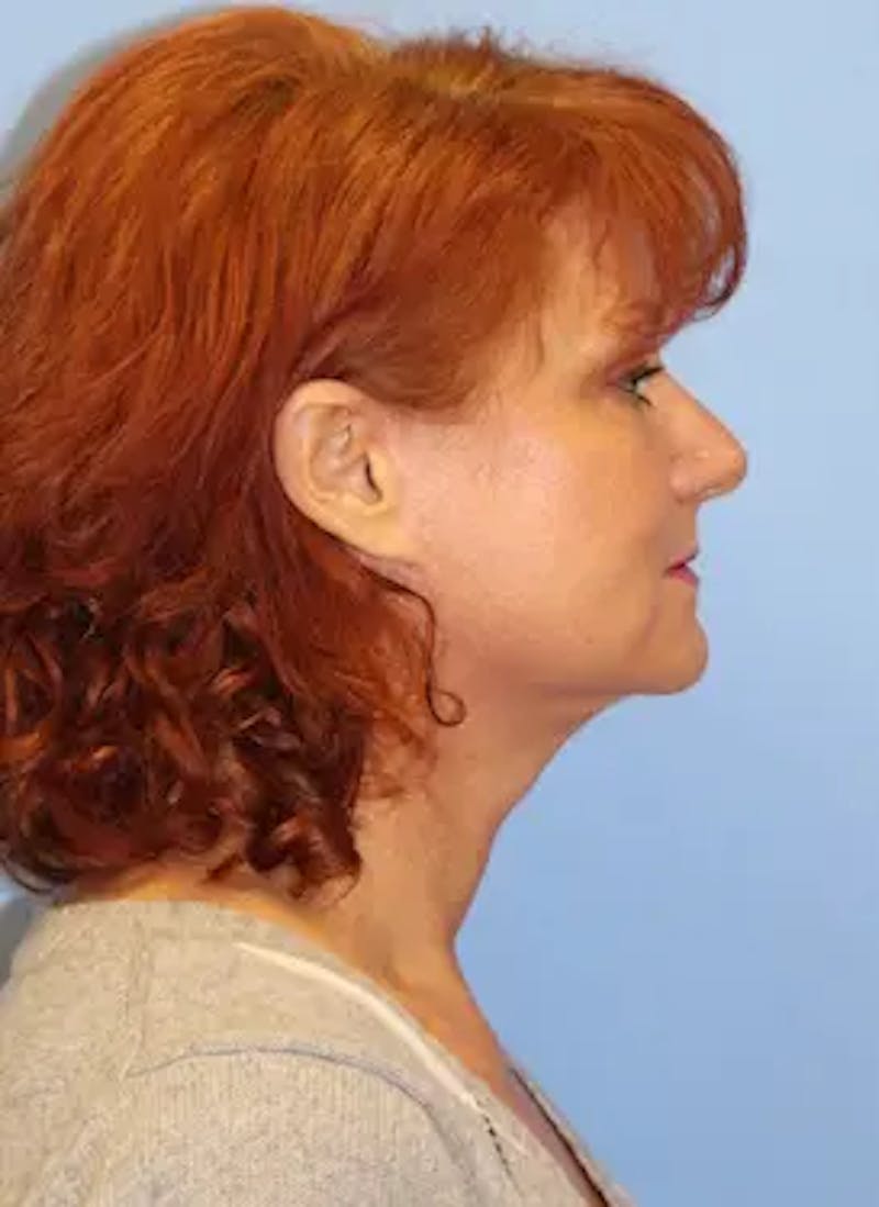 Facelift Before & After Gallery - Patient 302875 - Image 6