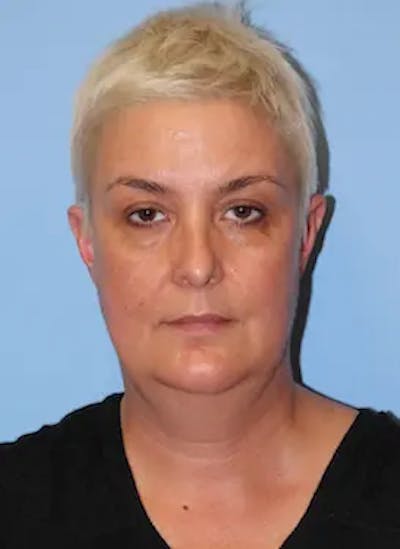 Facelift Before & After Gallery - Patient 259731 - Image 1