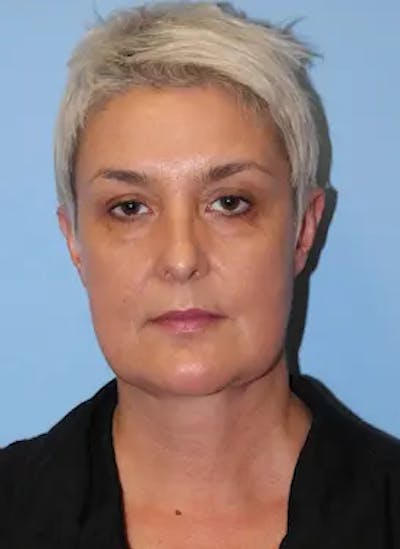 Facelift Before & After Gallery - Patient 259731 - Image 2
