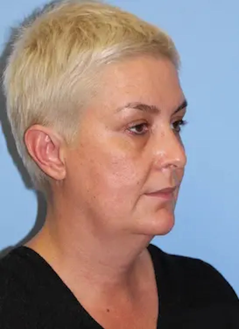 Facelift Before & After Gallery - Patient 259731 - Image 3
