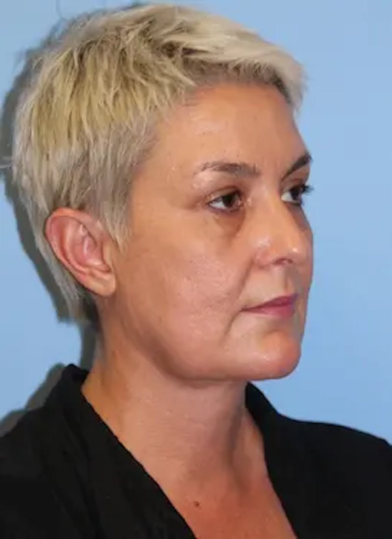 Facelift Before & After Gallery - Patient 259731 - Image 4