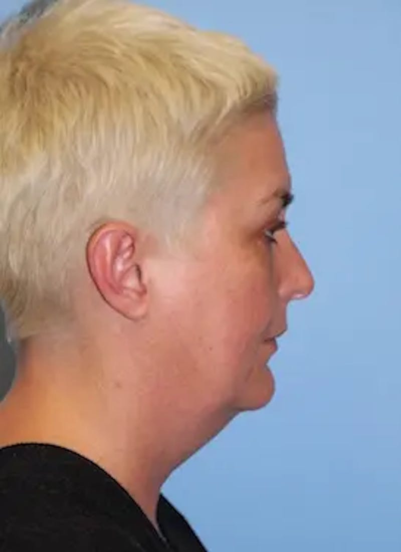 Facelift Before & After Gallery - Patient 259731 - Image 5