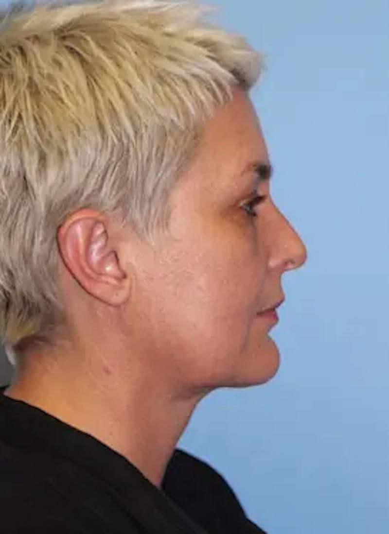 Facelift Before & After Gallery - Patient 259731 - Image 6