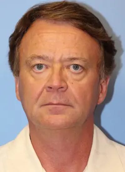 Facelift Before & After Gallery - Patient 206425 - Image 1