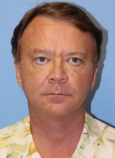 Facelift Before & After Gallery - Patient 206425 - Image 2