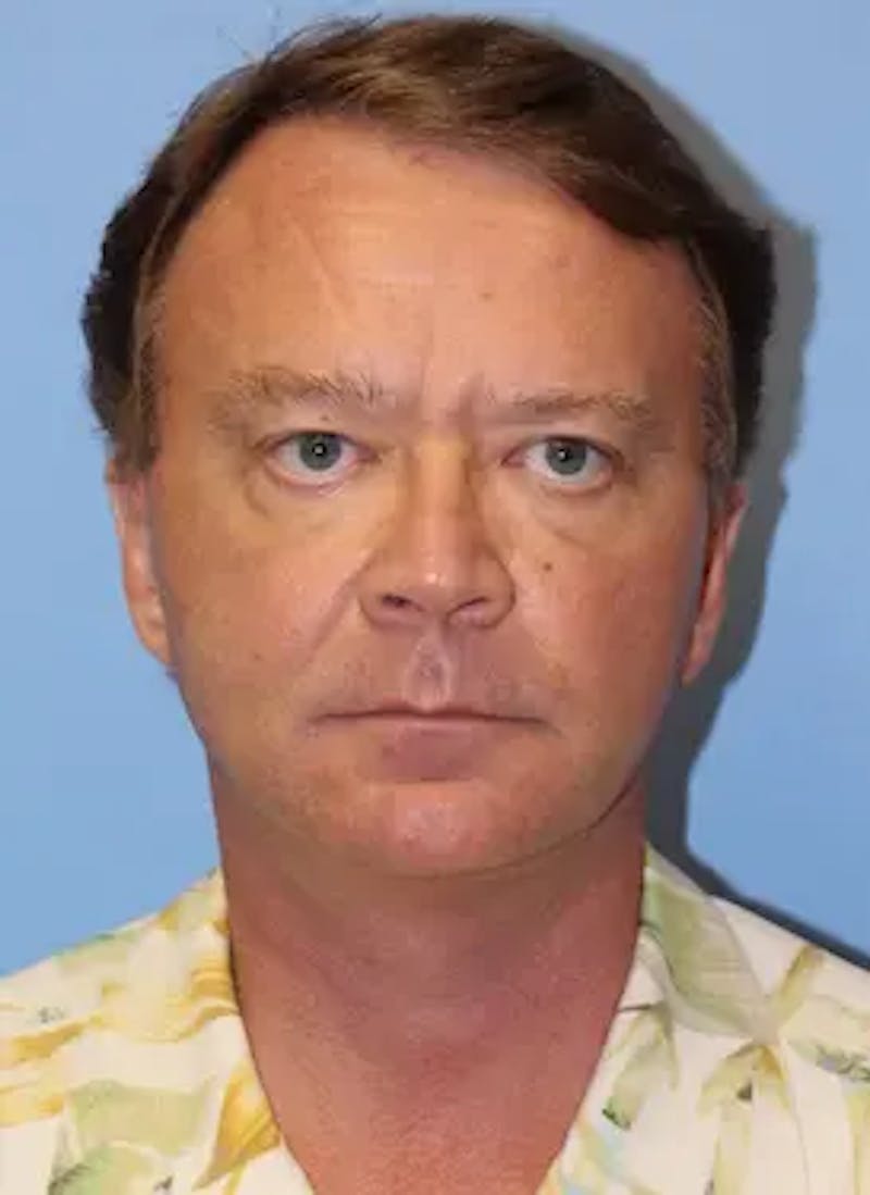 Male Facelift Before & After Gallery - Patient 401773 - Image 2