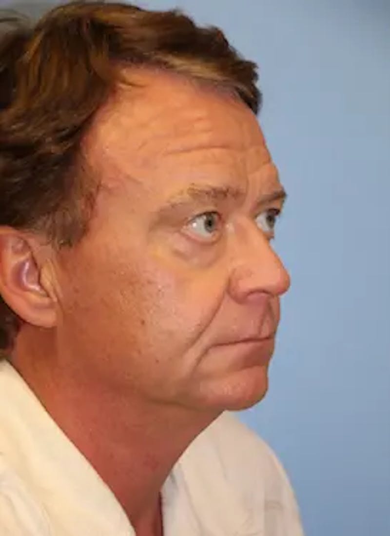 Male Facelift Before & After Gallery - Patient 401773 - Image 3