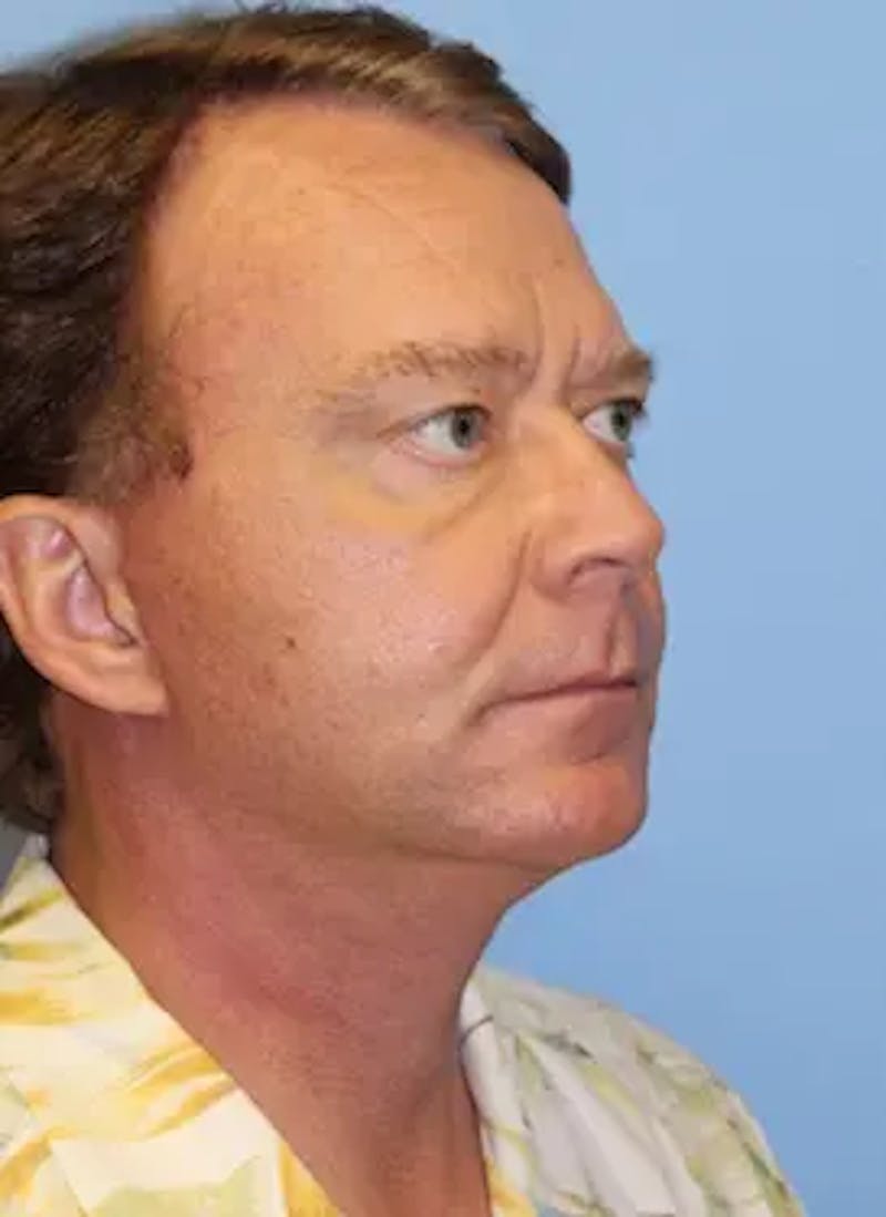 Male Facelift Before & After Gallery - Patient 401773 - Image 4