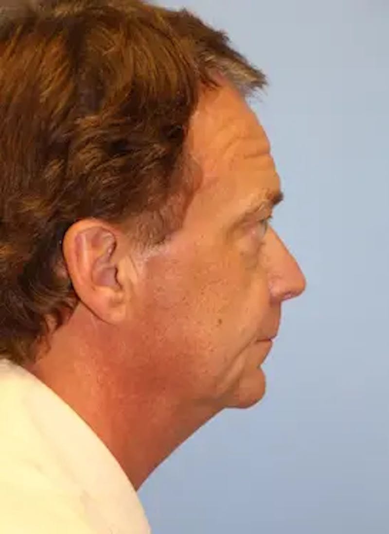 Male Facelift Before & After Gallery - Patient 401773 - Image 5