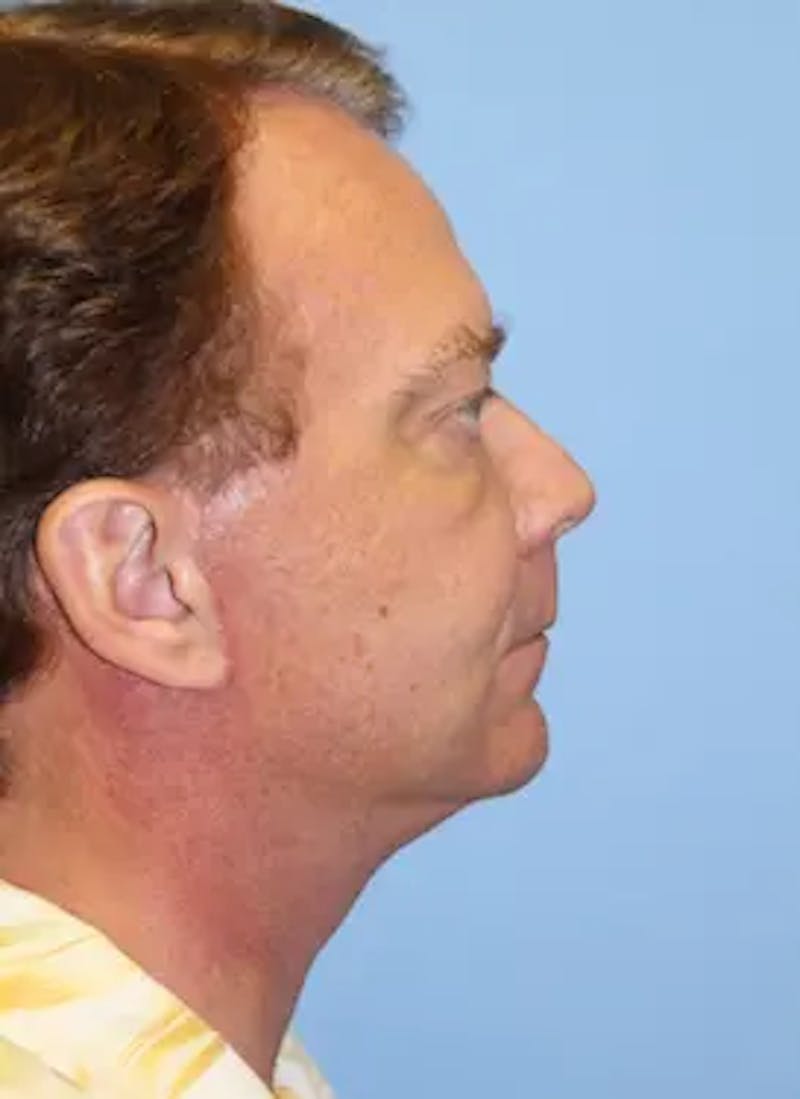 Male Facelift Before & After Gallery - Patient 401773 - Image 6