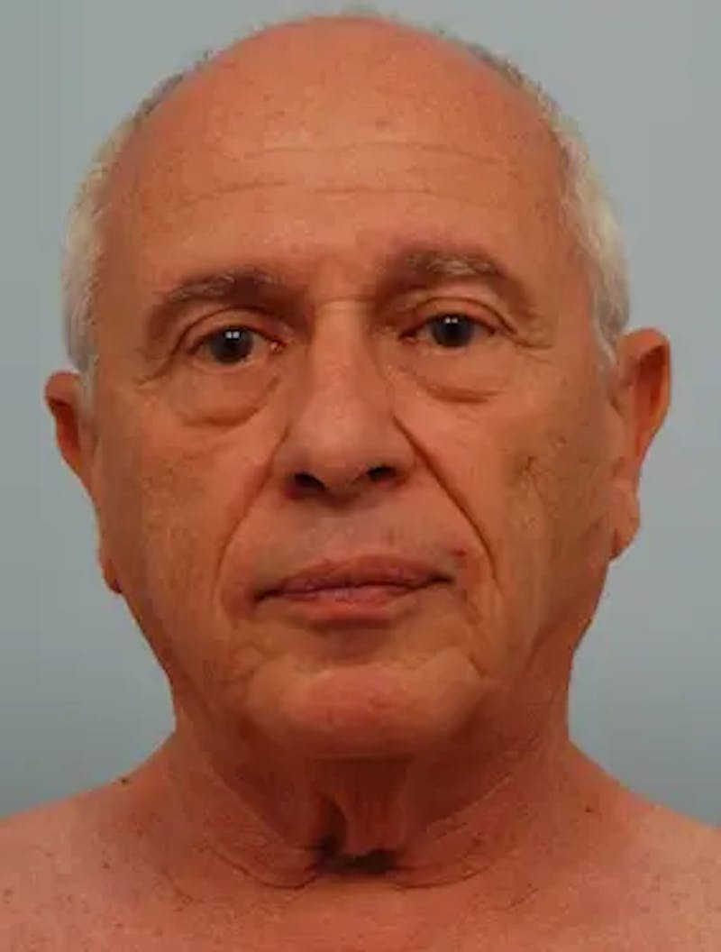 Neck Lift Before & After Gallery - Patient 380078 - Image 1