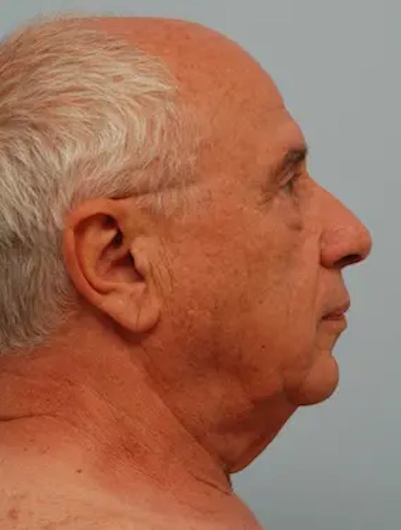 Neck Lift Before & After Gallery - Patient 380078 - Image 3