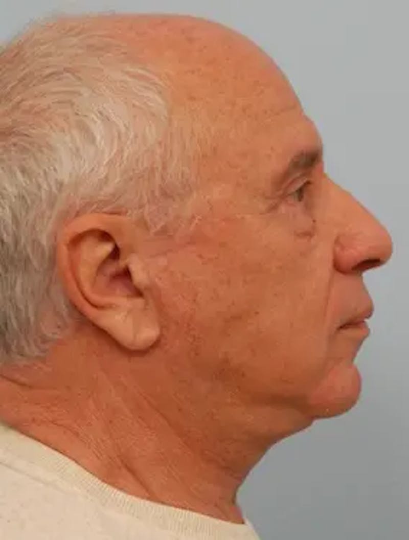 Neck Lift Before & After Gallery - Patient 380078 - Image 4