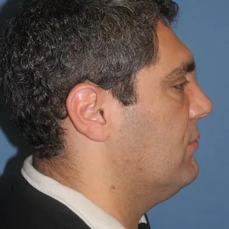 Neck Lift Before & After Gallery - Patient 149332 - Image 5