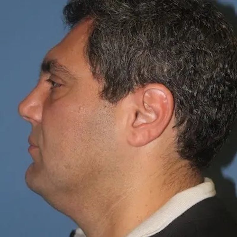 Neck Lift Before & After Gallery - Patient 149332 - Image 3