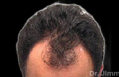 Neograft Hair Transplant System Before & After Gallery - Patient 232648 - Image 1