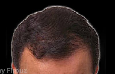 Neograft Hair Transplant System Before & After Gallery - Patient 232648 - Image 2