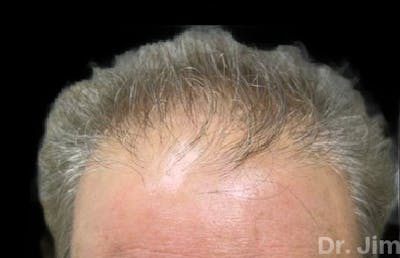 Neograft Hair Transplant System Before & After Gallery - Patient 176792 - Image 1