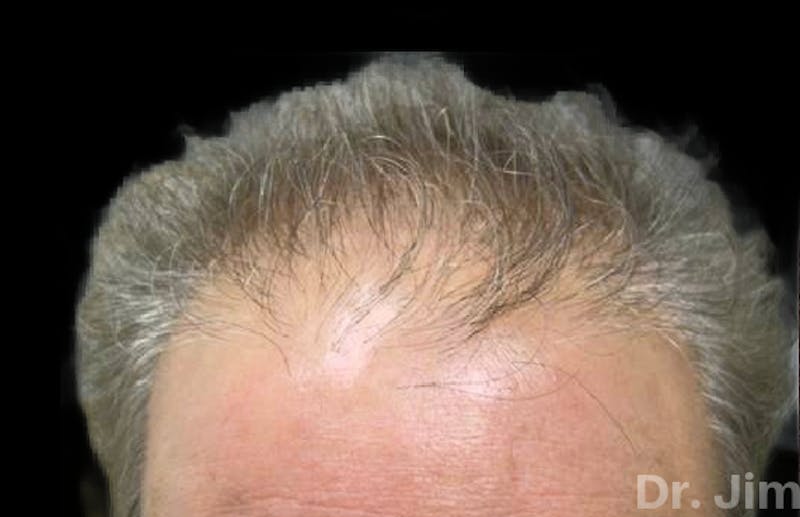 Neograft Hair Transplant System Before & After Gallery - Patient 176792 - Image 1