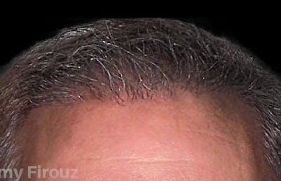 Neograft Hair Transplant System Before & After Gallery - Patient 176792 - Image 2