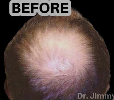Neograft Hair Transplant System Before & After Gallery - Patient 290268 - Image 1