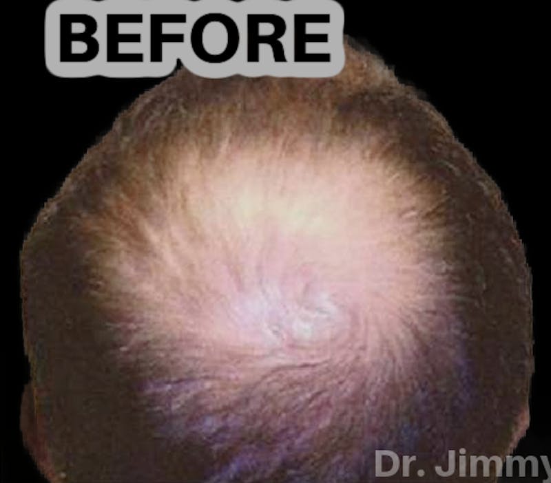 Neograft Hair Transplant System Before & After Gallery - Patient 290268 - Image 1