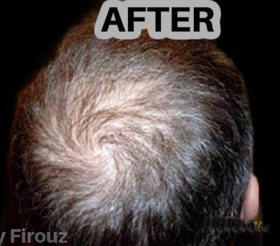 Neograft Hair Transplant System Before & After Gallery - Patient 290268 - Image 2