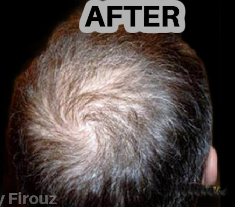 Neograft Hair Transplant System Before & After Gallery - Patient 290268 - Image 2