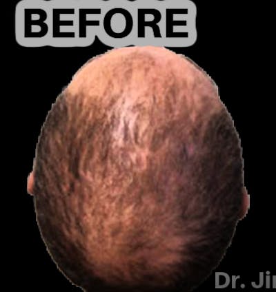 Neograft Hair Transplant System Before & After Gallery - Patient 219736 - Image 1