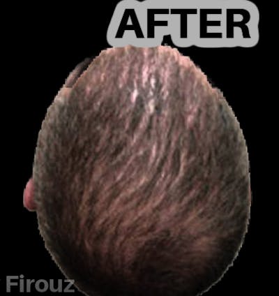 Neograft Hair Transplant System Before & After Gallery - Patient 219736 - Image 2