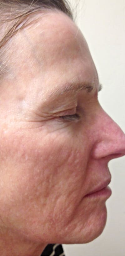 Microneedling Before & After Gallery - Patient 281818 - Image 1