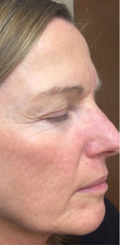 Microneedling Before & After Gallery - Patient 281818 - Image 2