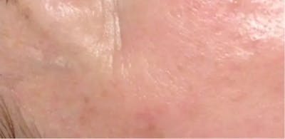 Microneedling Before & After Gallery - Patient 274587 - Image 1