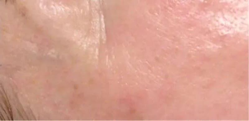 Microneedling Before & After Gallery - Patient 274587 - Image 1