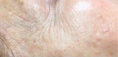 Microneedling Before & After Gallery - Patient 274587 - Image 2