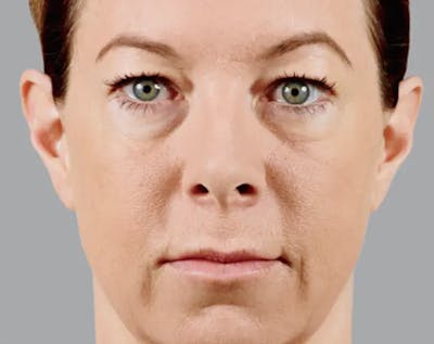 Injectable Fillers Before & After Gallery - Patient 996135 - Image 1