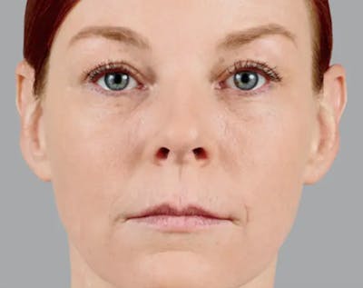 Injectable Fillers Before & After Gallery - Patient 996135 - Image 2
