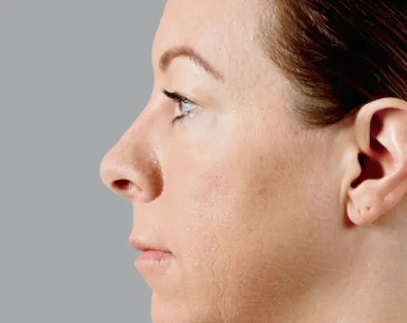 Injectable Fillers Before & After Gallery - Patient 996135 - Image 3