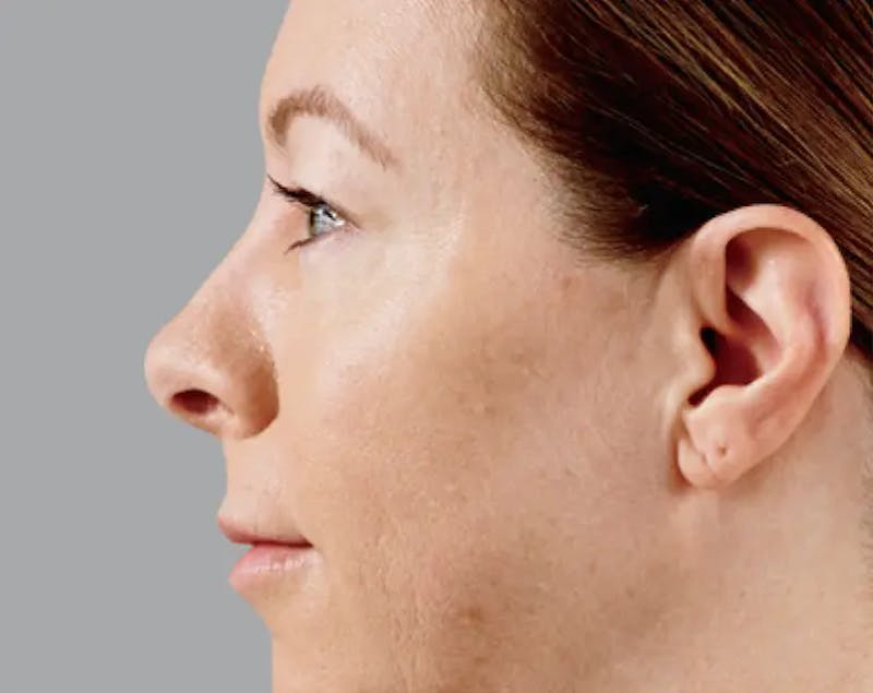 Injectable Fillers Before & After Gallery - Patient 996135 - Image 4