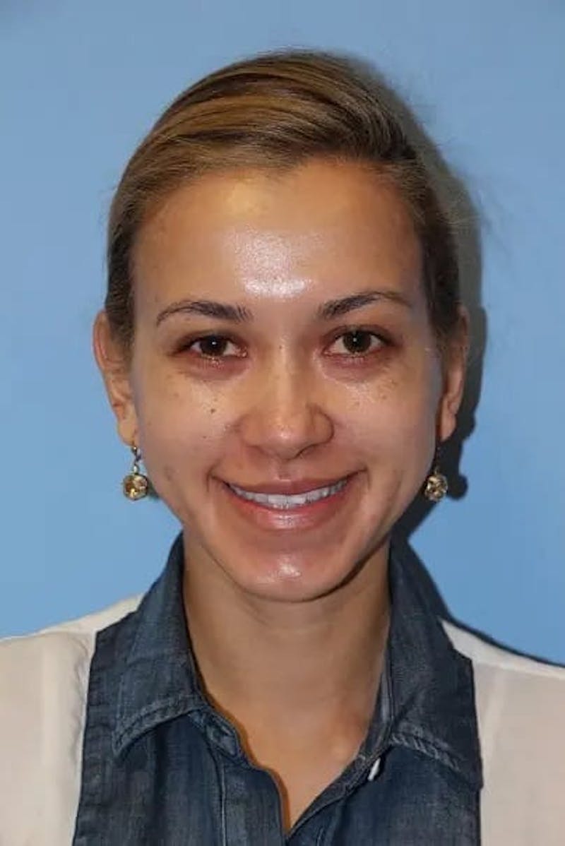Injectable Fillers Before & After Gallery - Patient 934209 - Image 5
