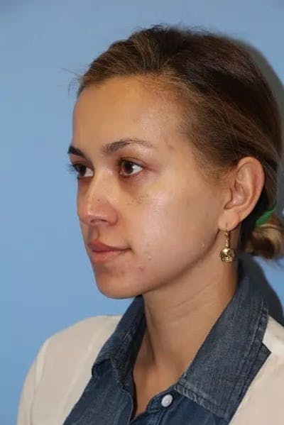 Injectable Fillers Before & After Gallery - Patient 934209 - Image 1