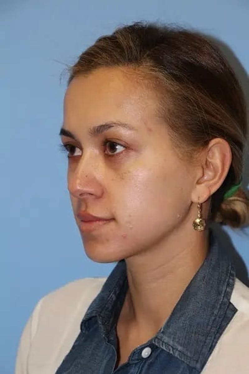 Injectable Fillers Before & After Gallery - Patient 934209 - Image 1