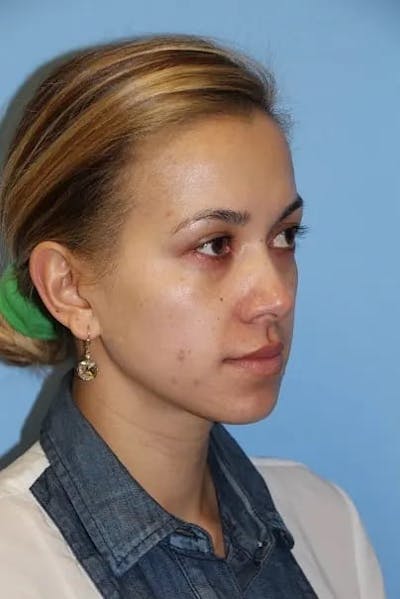 Injectable Fillers Before & After Gallery - Patient 934209 - Image 2