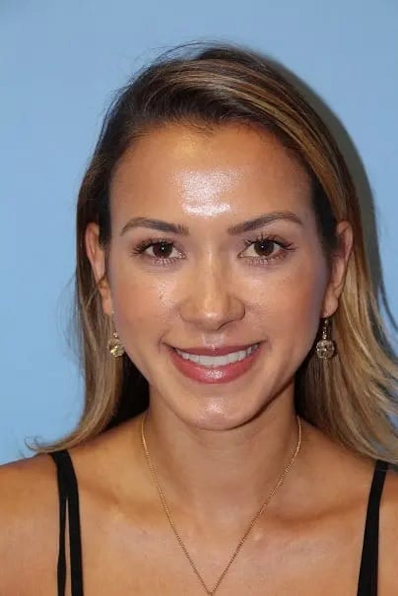 Injectable Fillers Before & After Gallery - Patient 934209 - Image 6