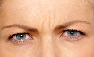 BOTOX® Cosmetic Before & After Gallery - Patient 238478 - Image 1