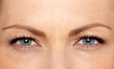 BOTOX® Cosmetic Before & After Gallery - Patient 238478 - Image 2