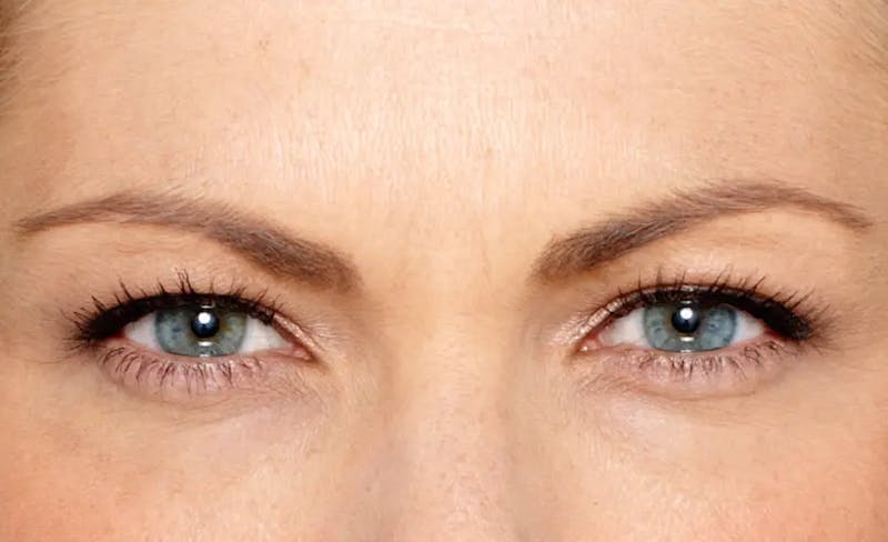 BOTOX® Cosmetic Before & After Gallery - Patient 238478 - Image 2