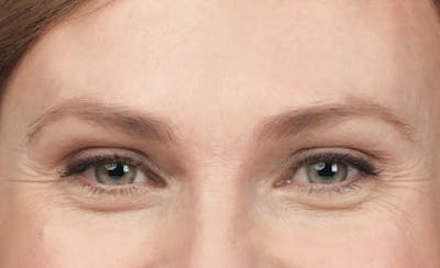BOTOX® Cosmetic Before & After Gallery - Patient 180972 - Image 1